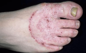 Dôvody vzhľadu huby na nohách