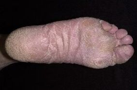 Príznaky a príznaky húb na nohách