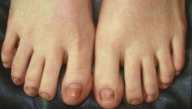 Fázy vývoja huby nechtov