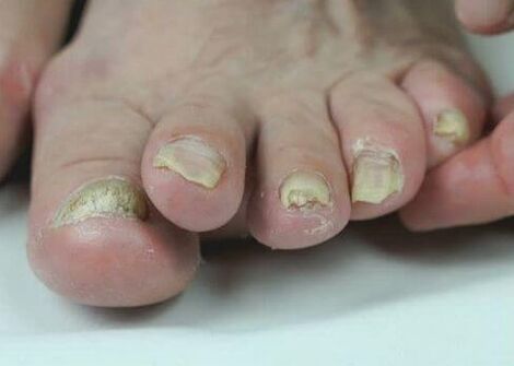 liečba plesní nechtov pomocou liekov
