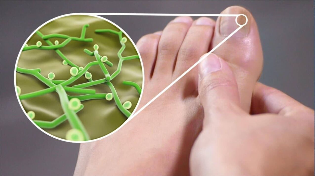 patogény plesní nechtov na nohách