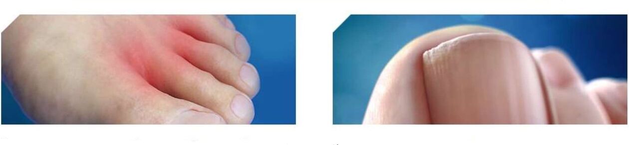 počiatočné štádium plesní na nohách